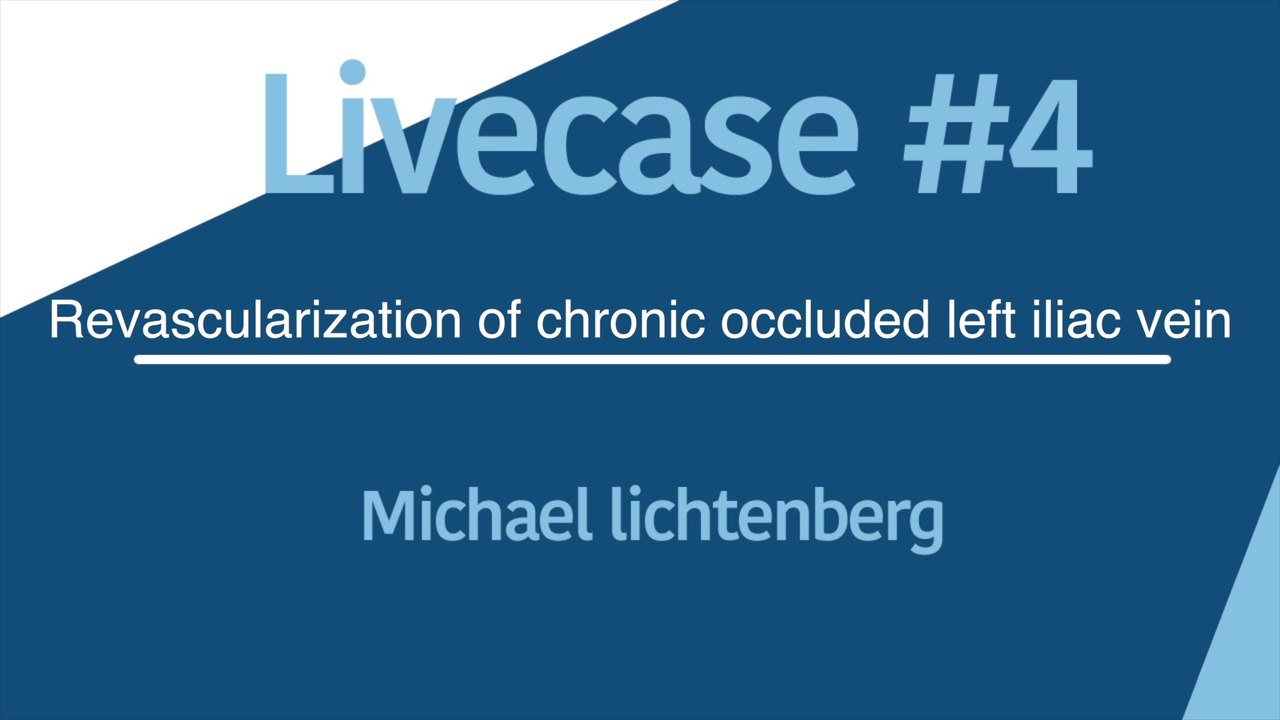 Live Case #4: Revascularization of chronic occluded left iliac vein