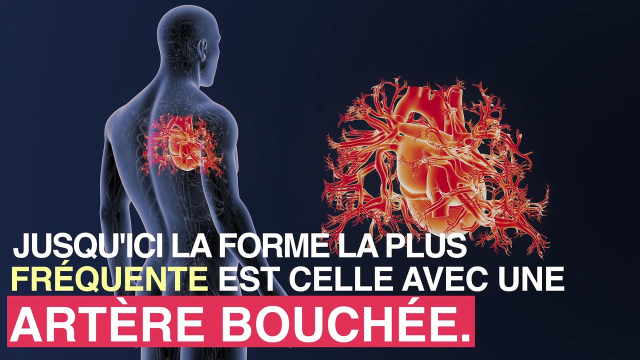 Infarctus : une forme sans obstruction existe