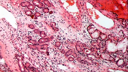 알레르기 또는 부비동염 (787 Hz)에 대한 음향 치료 - 30 분