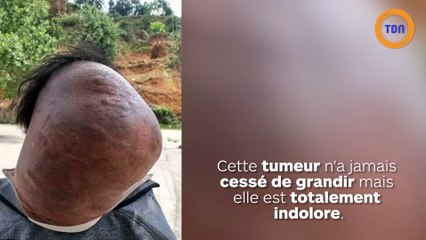 Cet homme a une  énorme bosse sur la nuque