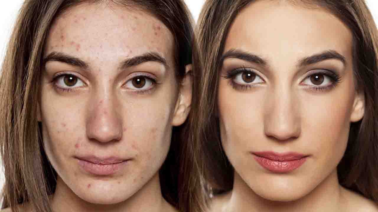 Acne Spots & Age spots; Find out the Difference...
