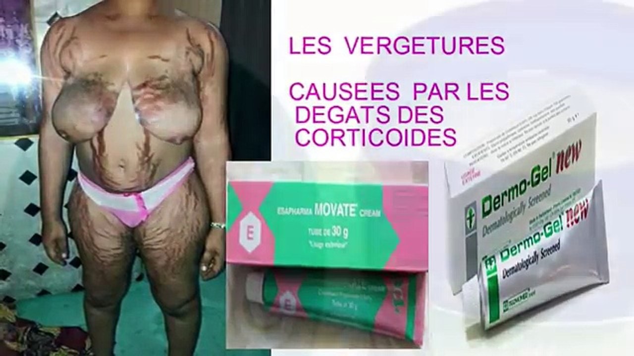 Traitement Efficace Des Vergetures et Dégâts Corporels Dû Aux Corticoïdes