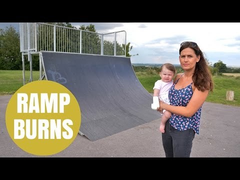 One-Year-Old Girl Suffers Horrific Burns After Skate Ramp Hits 51 Degrees
