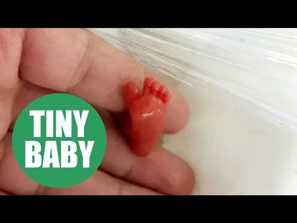 One of the world's smallest babies ever to survive