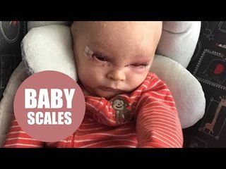 Boy with condition that makes skin scale like a fish finally finds relief with cannabis oil