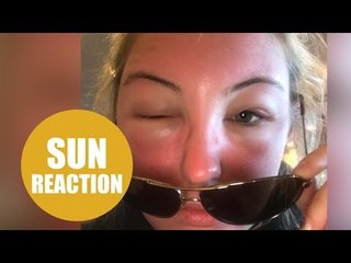 Student's face "BLEW UP" after being 'poisoned' by the sun's UV rays