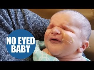Parents shocked when told their new baby is born without eyes
