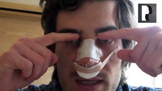 2 Male Rhinoplasty Nose Job Diary Day 1 After Surgery