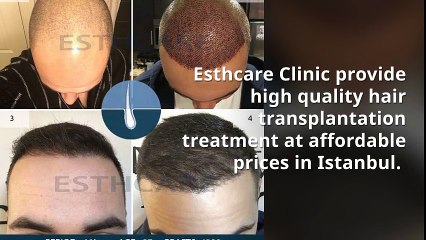 Hair Transplant in Istanbul at reasonable price