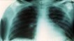 Bronşit, astım, akciğer tamiri için ses tedavisi - 30 dakika