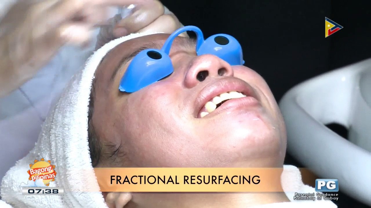 DERMAESTHETIQUE: Fractional resurfacing