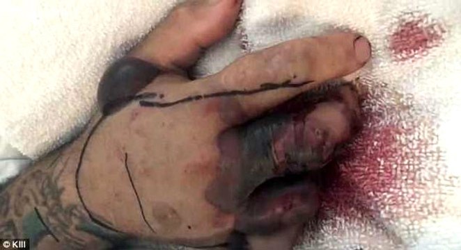 Genç Adam Kafasını Kestiği Yılan Tarafından Isırıldı, Ölümden Döndü