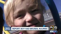 Medical report shows toddler had bruises 'too numerous to count' but died from flu complications