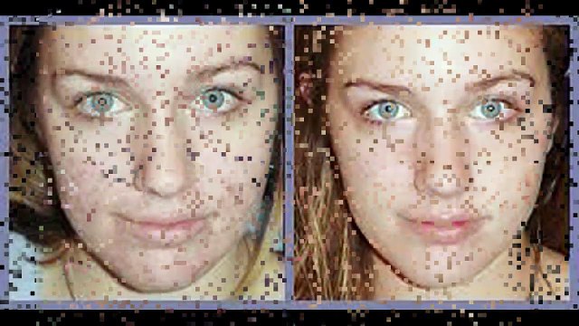 Sivilce izleri nasıl geçer?