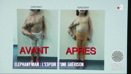 Santé - Elephant Man : l’espoir d’une guérison