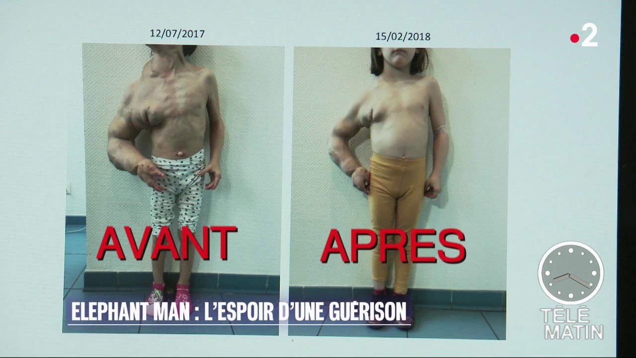Santé - Elephant Man : l’espoir d’une guérison