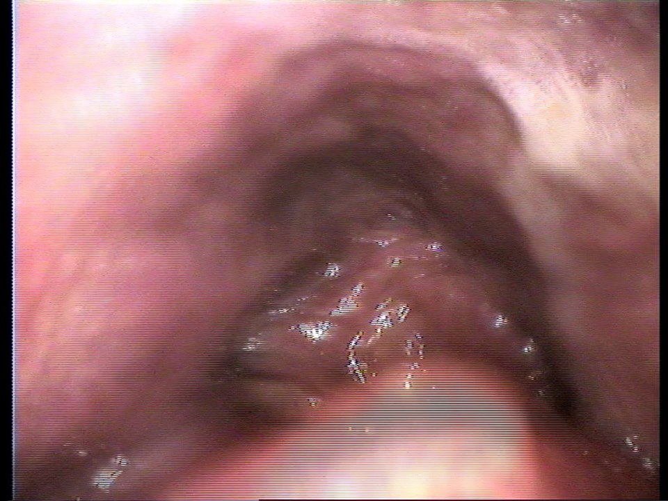 Patient 4 Nasofibroscopie Post-op