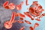 Journée mondiale de la drépanocytose : une journée pour s'informer