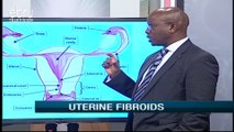 What are the Signs and Symptoms of Uterine Fibroids