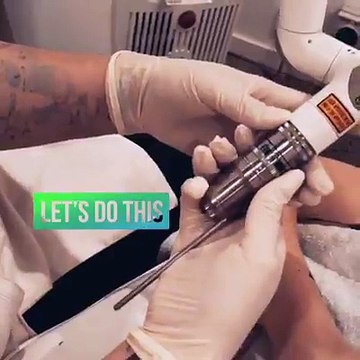 Best Offer Laser Tattoo Removal - Fresh Skin Canvas