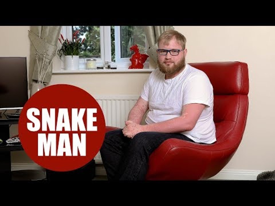 Hospital worker tells how painful psoriasis has turned him into a "human snake"