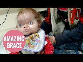 Toddler with rare condition defies doctors to sit up for the first time