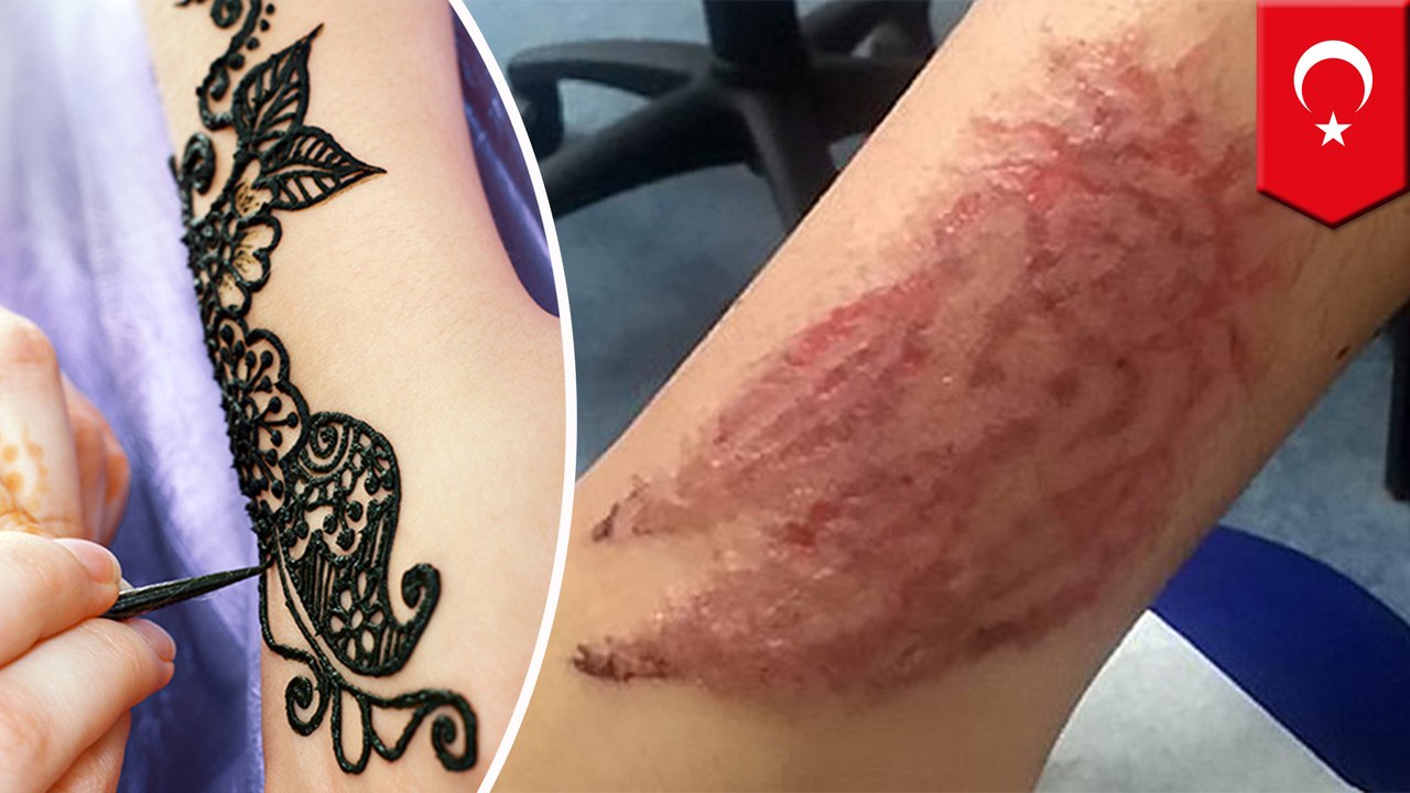 Toxic black henna tattoos may scar you for life