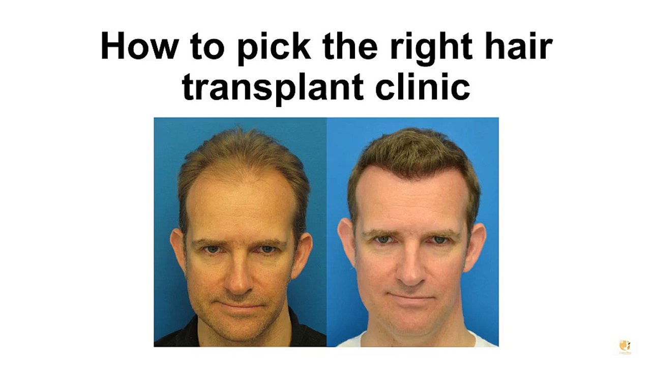 How to pick the right hair transplant clinic