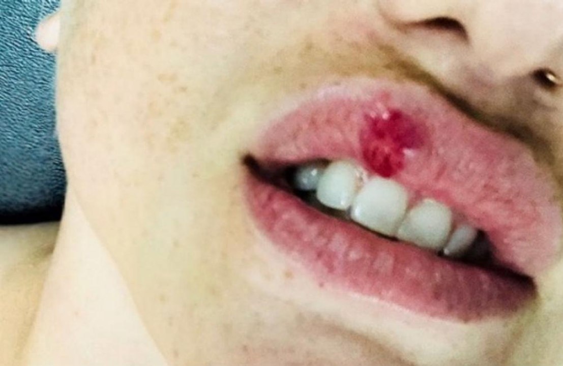 Kesha hat sich an der lippe verletzt
