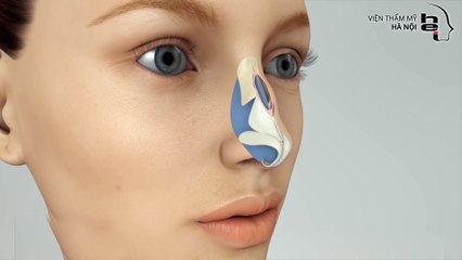 Tìm hiểu về phương pháp phẫu thuật chỉnh gồ xương mũi
