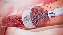 New Device Removes Blood Clots Much More Efficiently -MegaVac