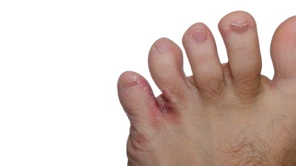 Foot Fungus  - Remedies: बरसात के पानी से हो गया है पैरों में फंगस तो ऐसे करें दूर | Boldsky