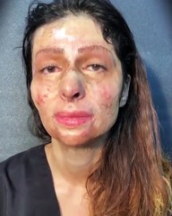 فتاة تضع مكياجاً لأول مرة على وجهها المحروق فجاءت النتيجة تبكي القلوب