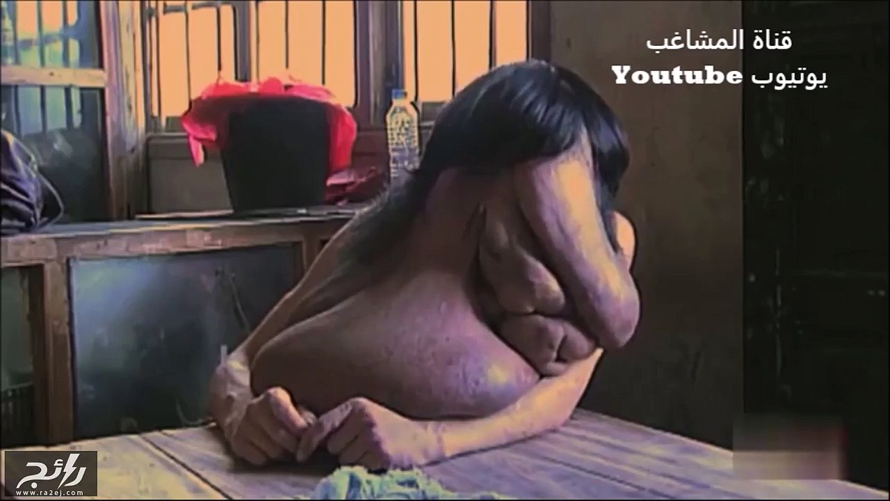 هل سمعت من قبل عن رجل يعيش بوجه فيل!