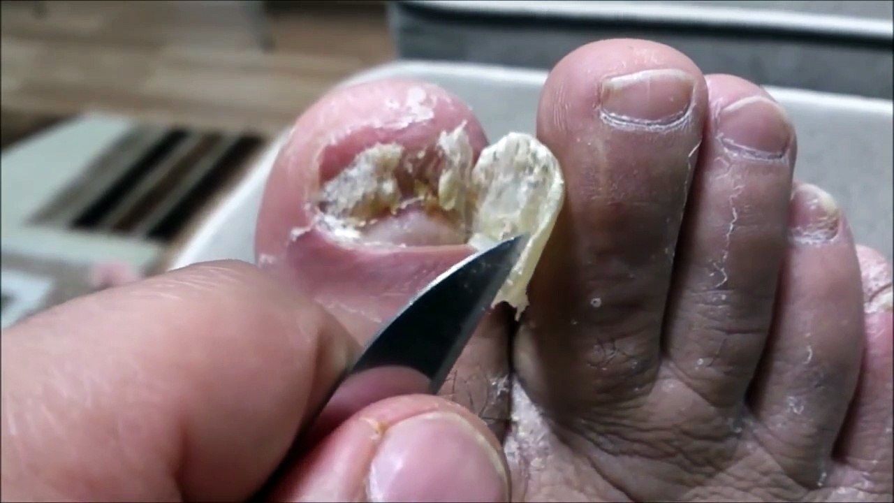 Reduce The Nail...
