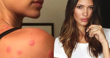 İki Yıl Önce Tahtakurusu Isıran Victoria's Secret modeli Sabrina Jales Pierre'nin Görüntüleri Ortaya Çıktı