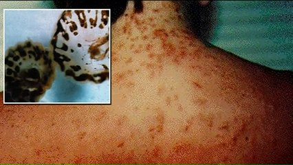 Sea Lice Reported at Florida Beaches