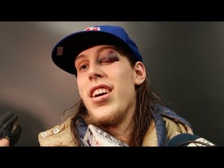 Kelly Olynyk's on his Gruesome Black Eye vs Indiana Pacers