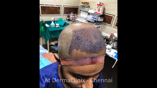 4000 Grafts, Best Hair Transplant in Chennai @DERMACLINIX | Dr Ariganesh Chandrasegaran, MD