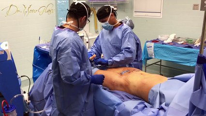 Why do I need fat transfer to get an hourglass shape?