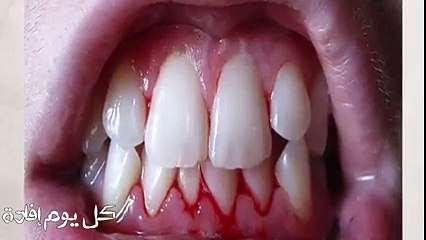 ازالة رواسب الأسنان فقط في البيت ودون الذهاب إلى الطبيب بهذه الطريقة الرائعة لا تفوتكم