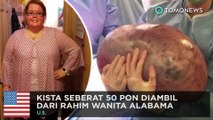 Kista seberat 50 pon diambil dari rahim wanita - TomoNews