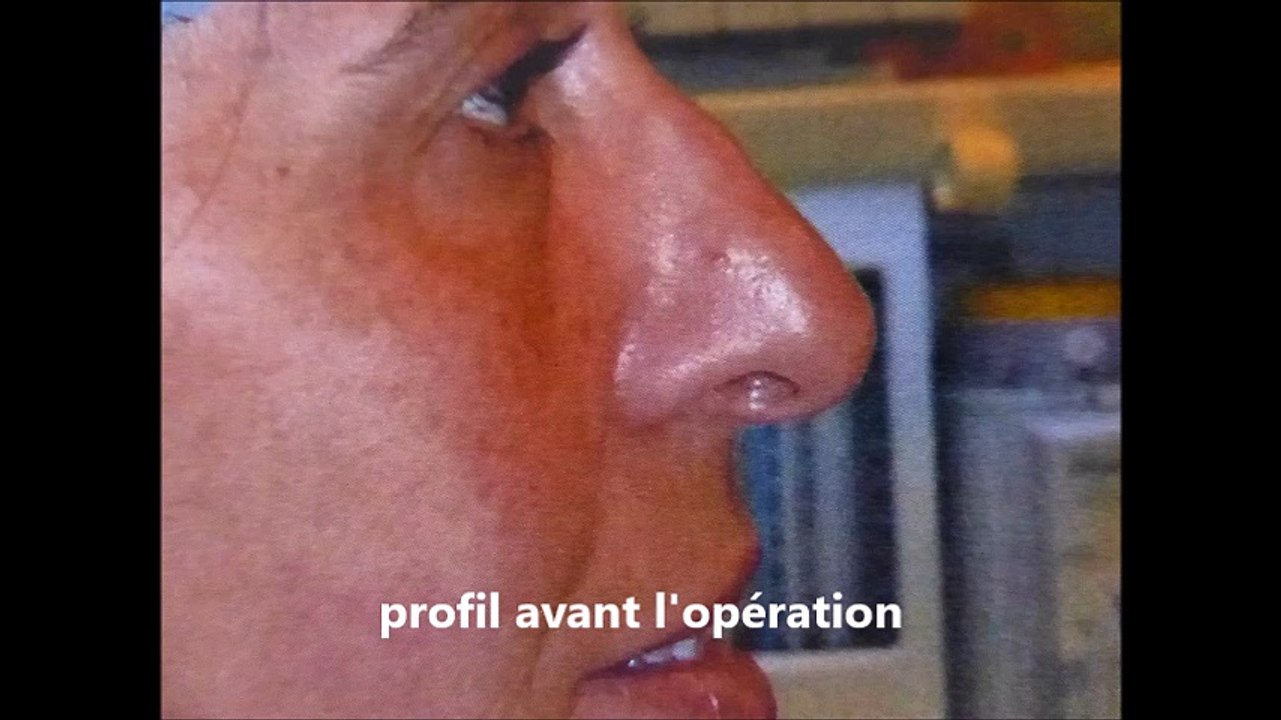 nez dévié correction après 6 mois par le Dr VladimirMitz