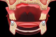 Was tun bei Zahnprothesen Druckstellen