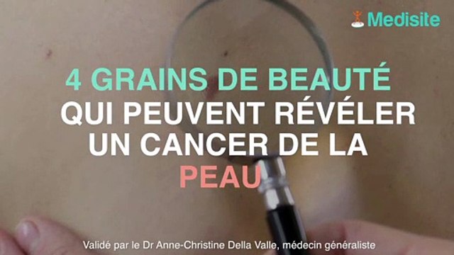 4 grains de beauté qui peuvent révéler un cancer de la peau