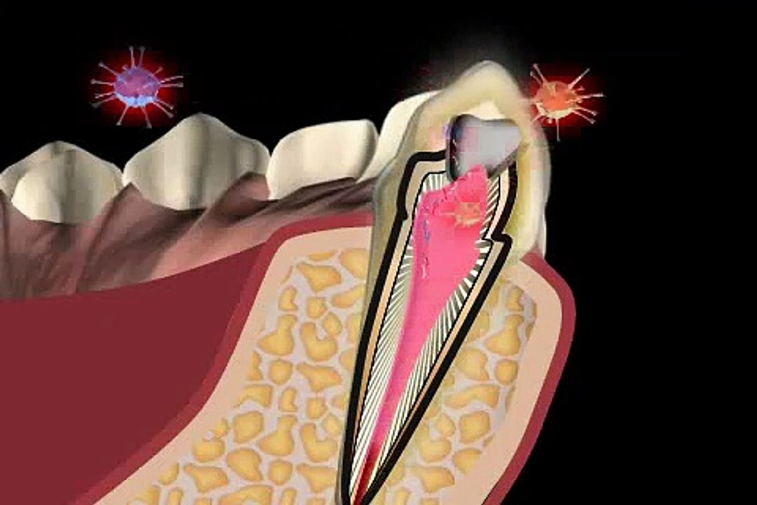 was macht man mit einem dunklem Zahn - ein internes Bleaching!