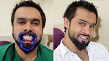 Hollywood Smile Makeover @FMS Dental™ - Best Cosmetic Dental Clinic - Hyderabad, India