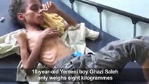 Starvation leaves Yemeni boy Ghazi too weak to cry