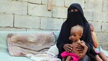 Fome e doenças matam 85.000 crianças no Iêmen