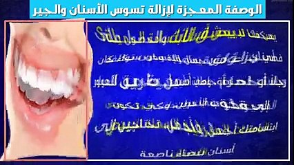 الوصفة المعجزة لإزالة تسوس الأسنان والجير فى يوم واحد فقط